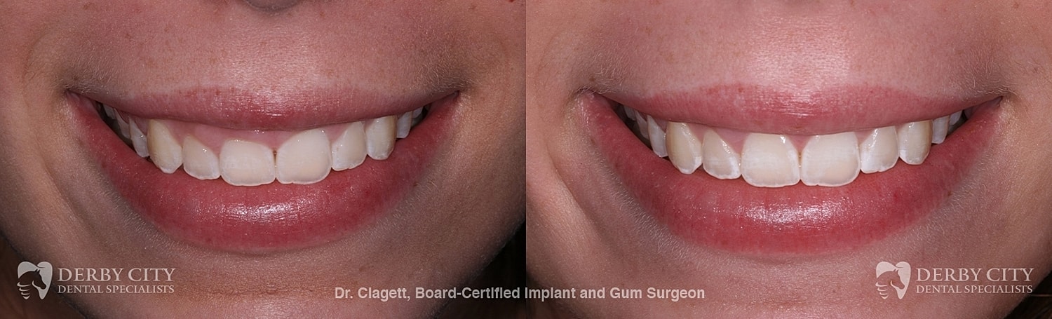 Gum Lift Before & After