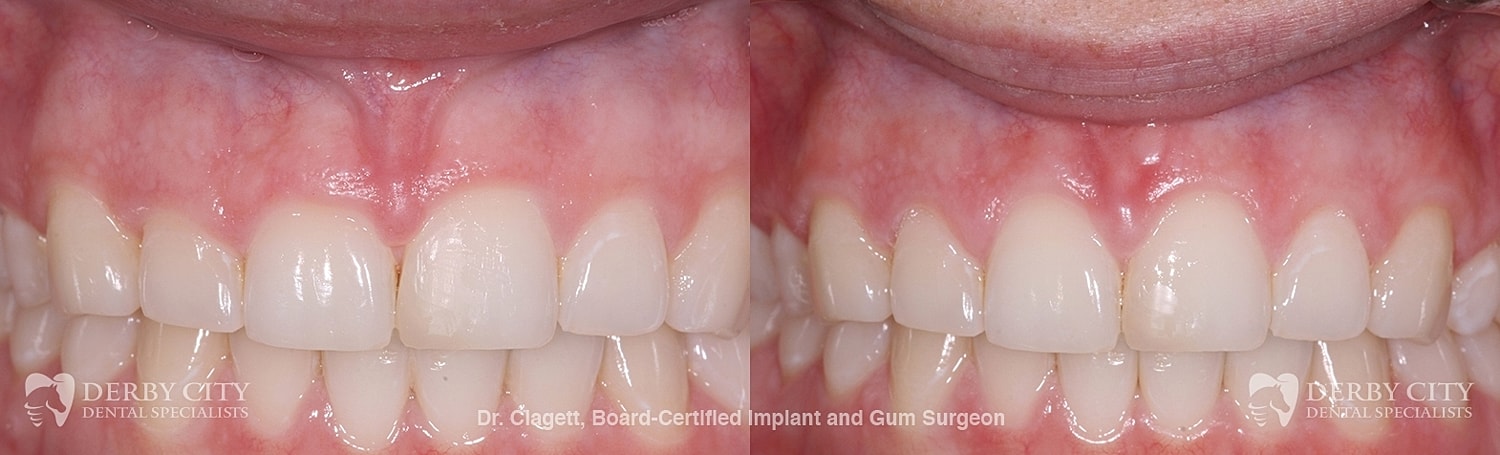 Gum Lift Before & After