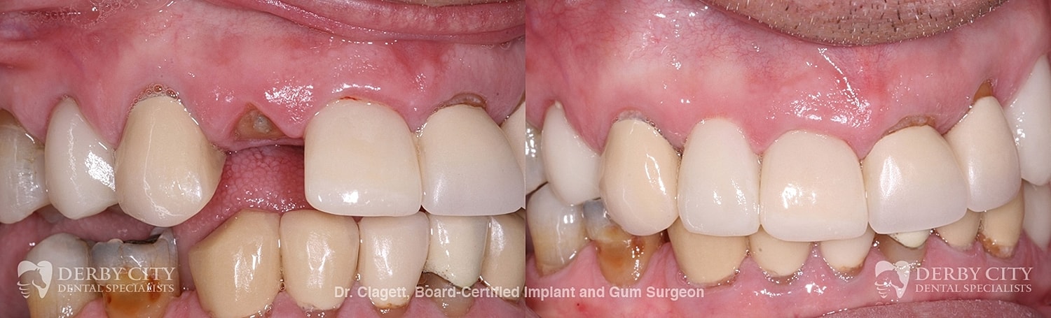 Implants Before & After