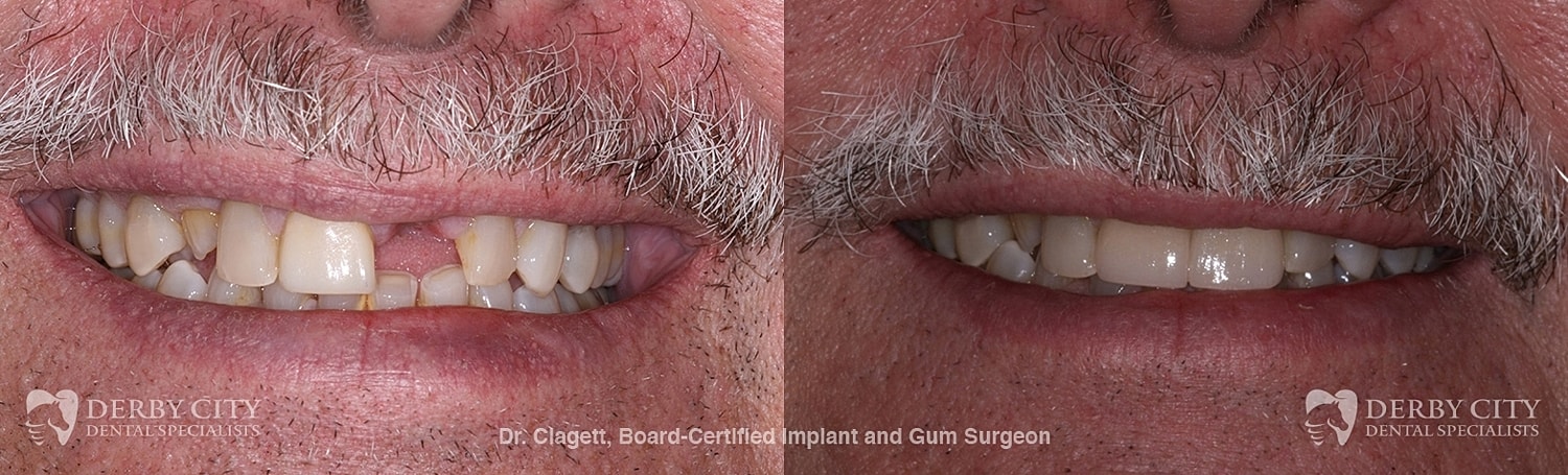 Implants Before & After