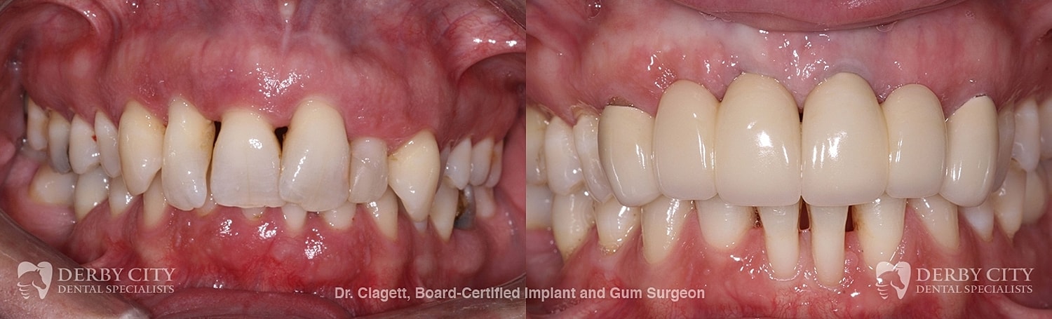 Implants Before & After