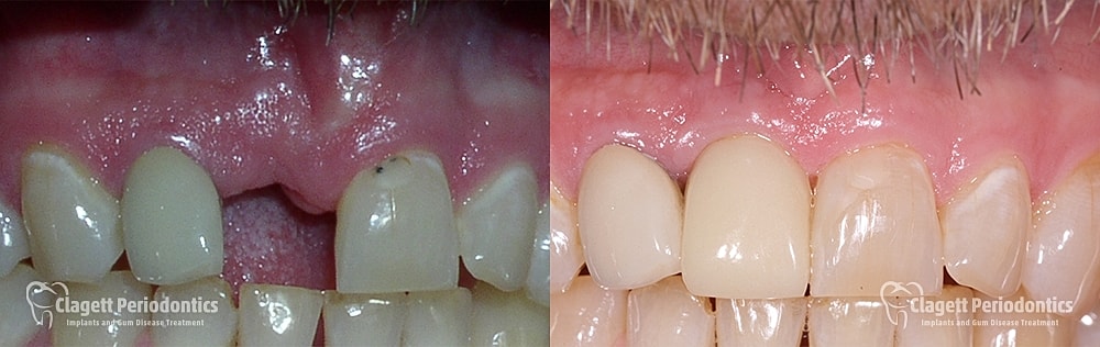 Implants Before & After