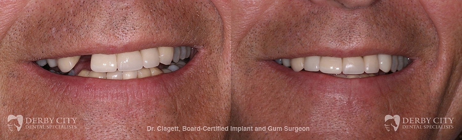 Implants Before & After
