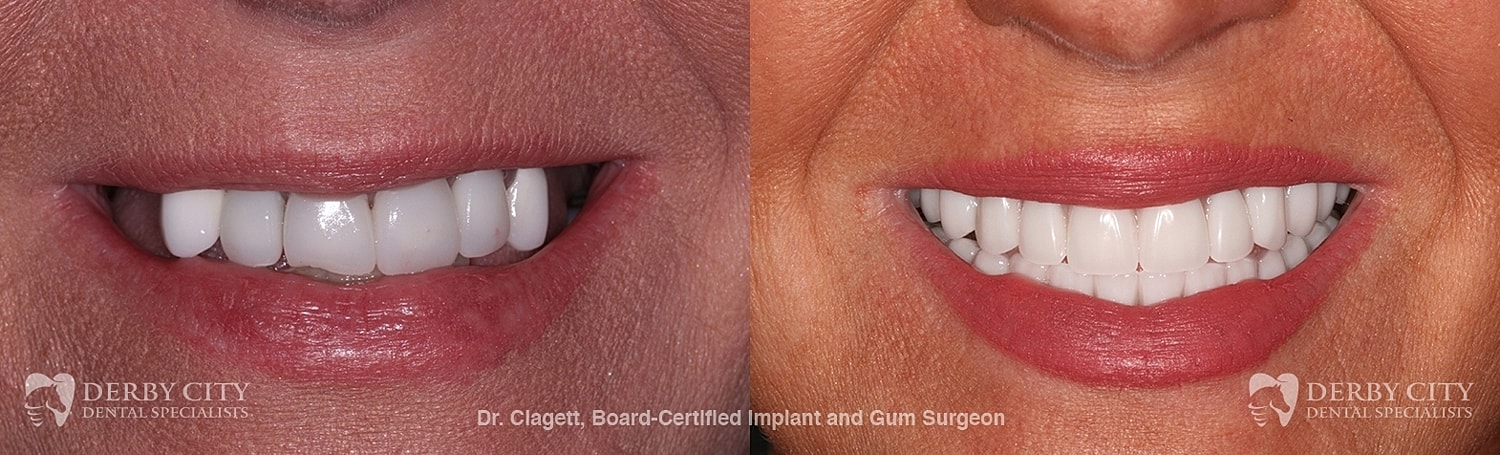 Implants Before & After