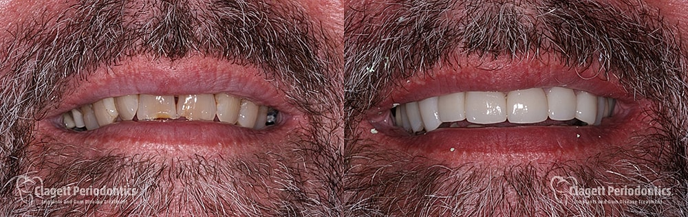 Implants Before & After