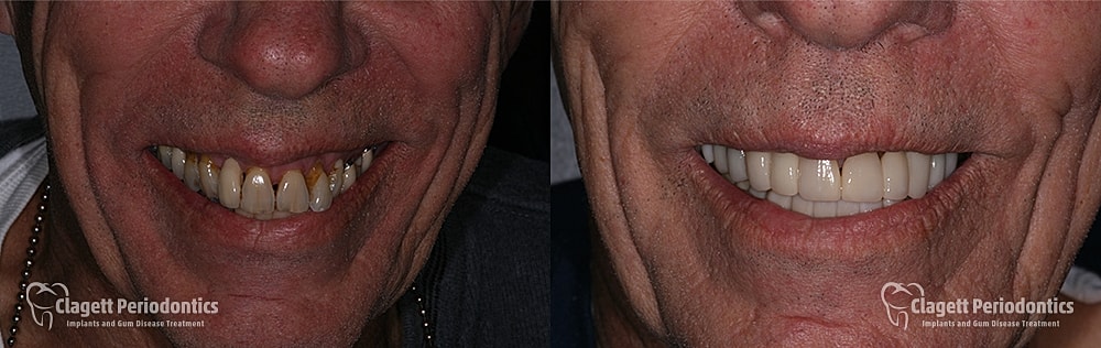Smile Makeover Before & After