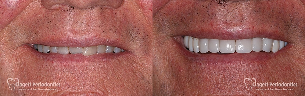 Smile Makeover Before & After