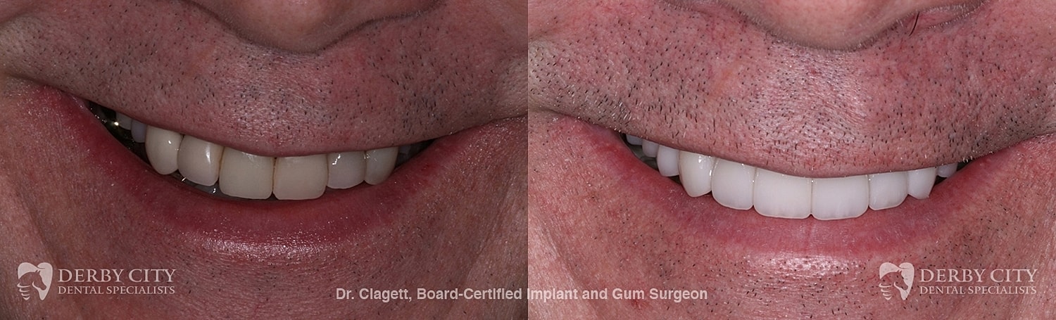 Smile Makeover Before & After