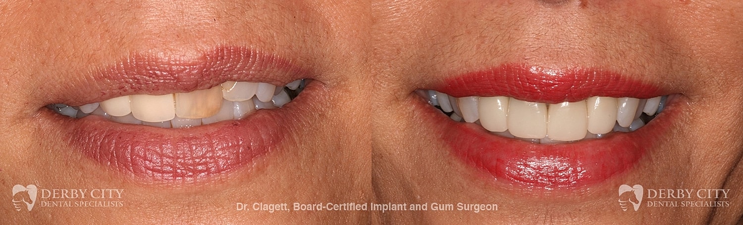 Smile Makeover Before & After