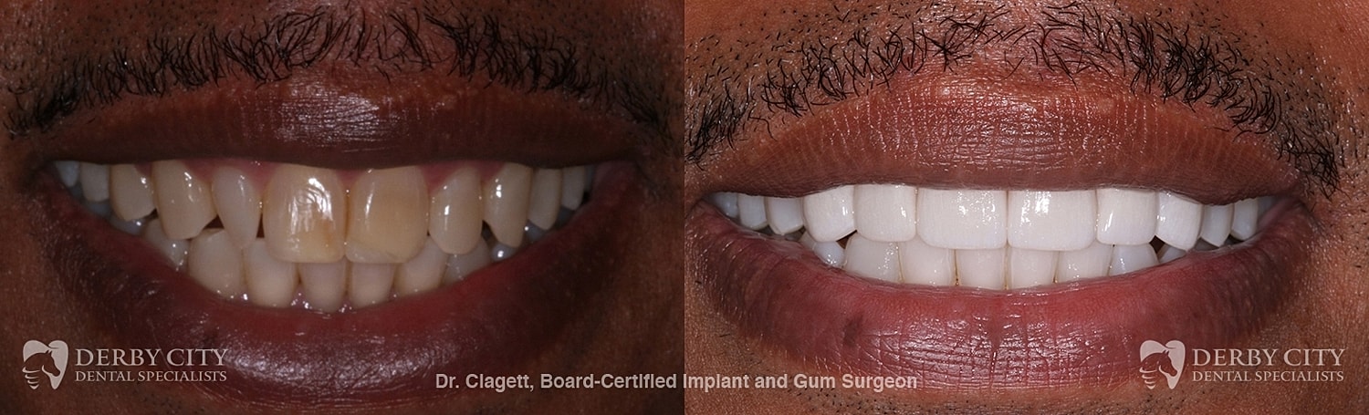Smile Makeover Before & After