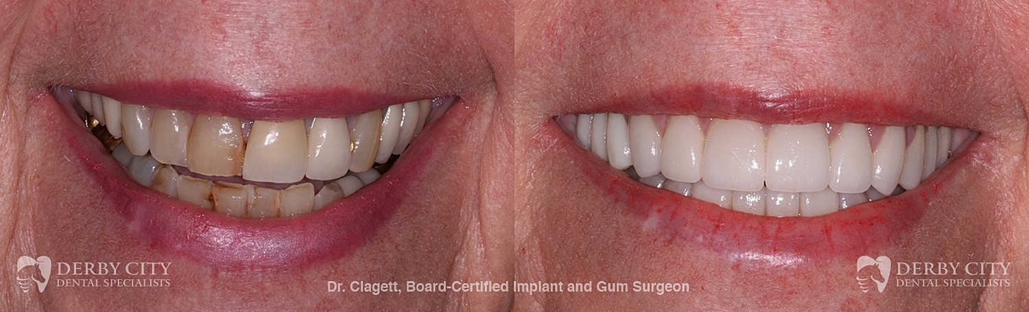 Smile Makeover Before & After