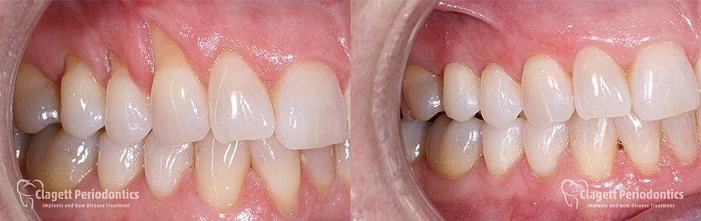 Gum Recession Before & After