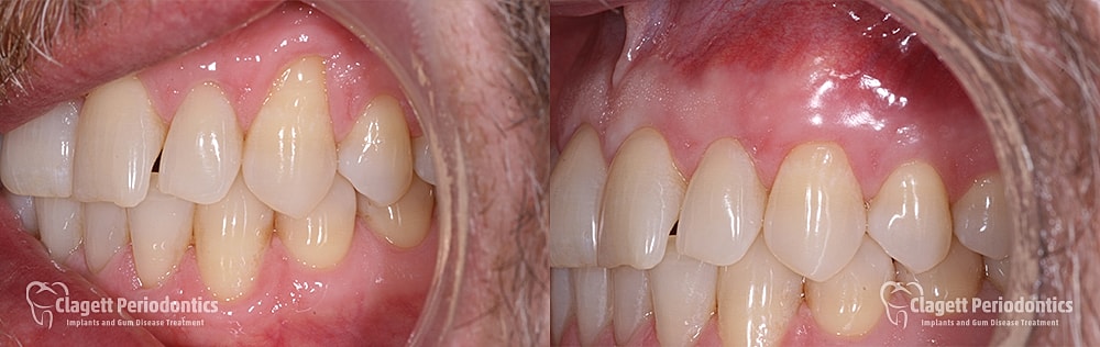 Gum Recession Before & After