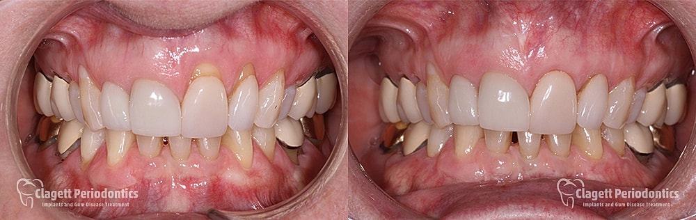 Gum Recession Before & After