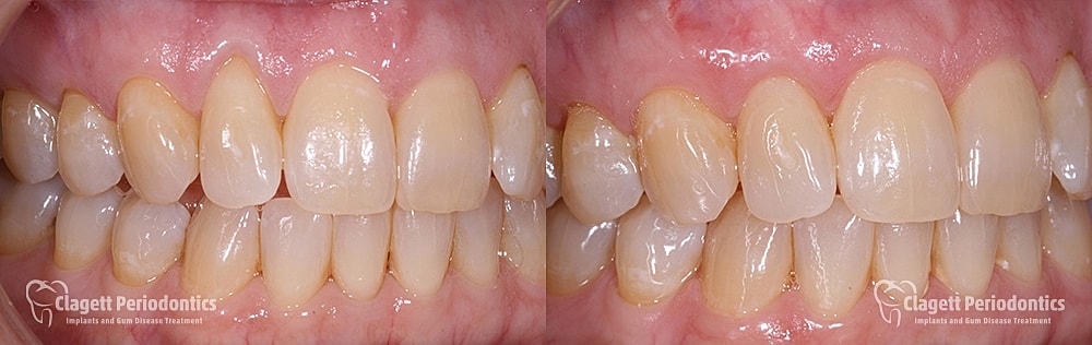 Gum Recession Before & After