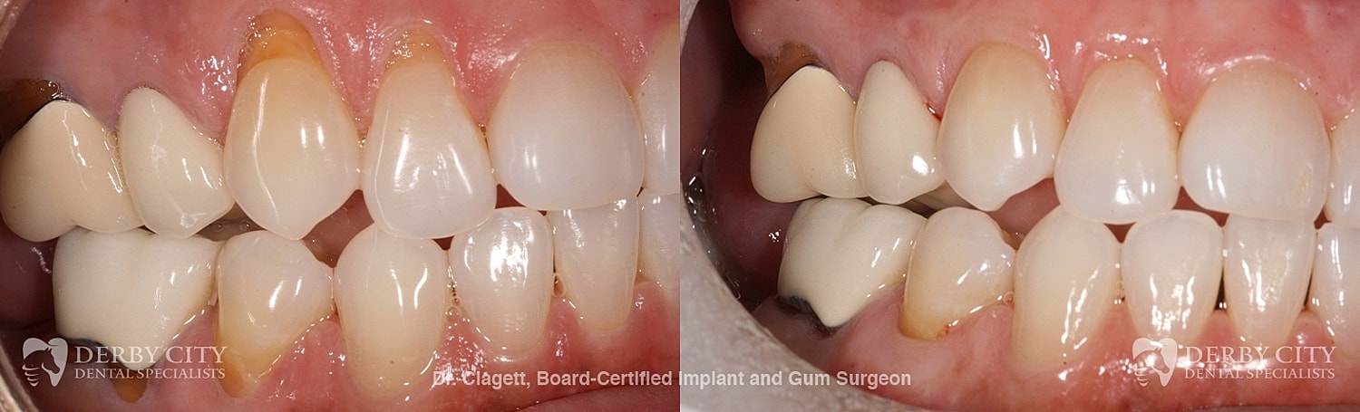 Gum Recession Before & After