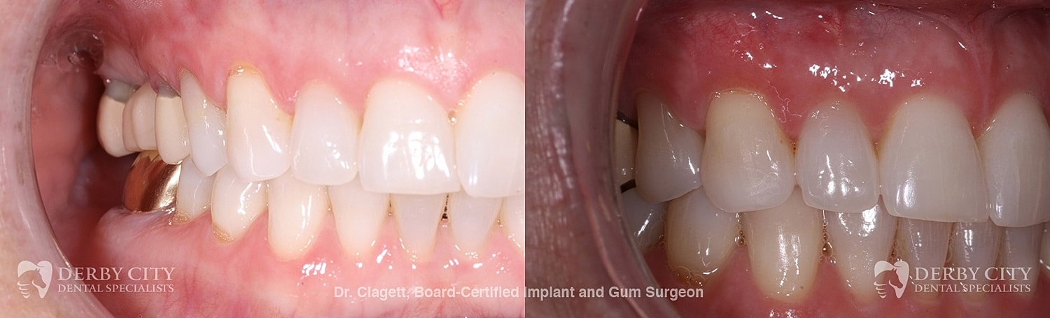 Gum Recession Before & After