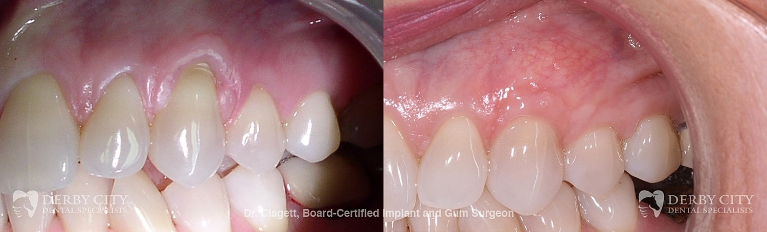 Gum Recession Before & After