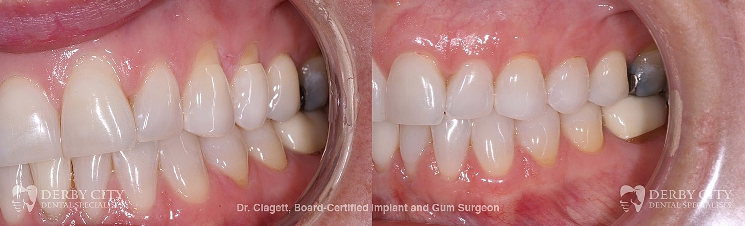 Gum Recession Before & After